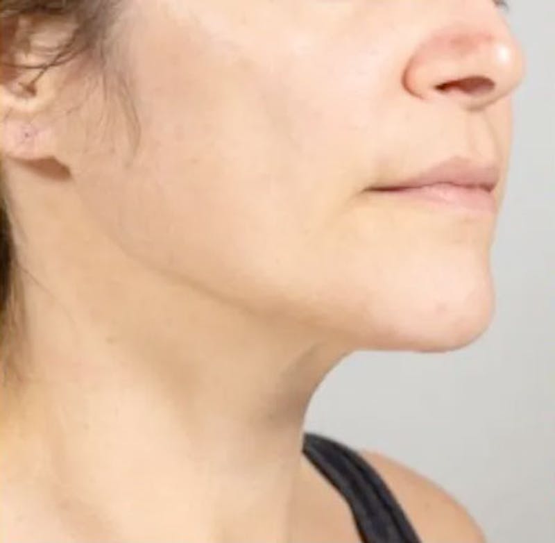Ultherapy Skin Tightening Before & After Gallery - Patient 283797 - Image 2