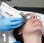 fraxel laser