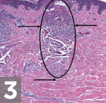 fraxel laser