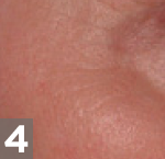 fraxel laser