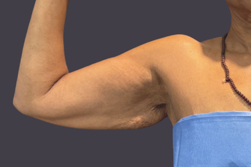 Armlift Surgery Before & After Gallery - Patient 143912 - Image 1