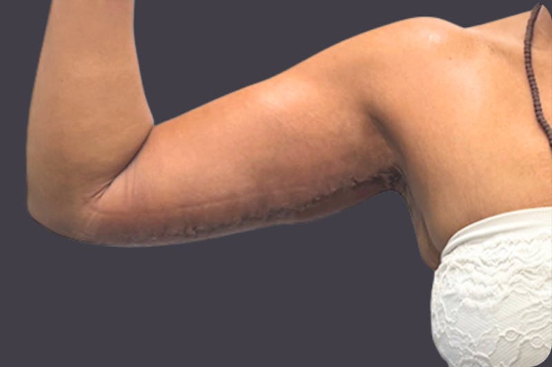 Armlift Surgery Before & After Gallery - Patient 143912 - Image 2