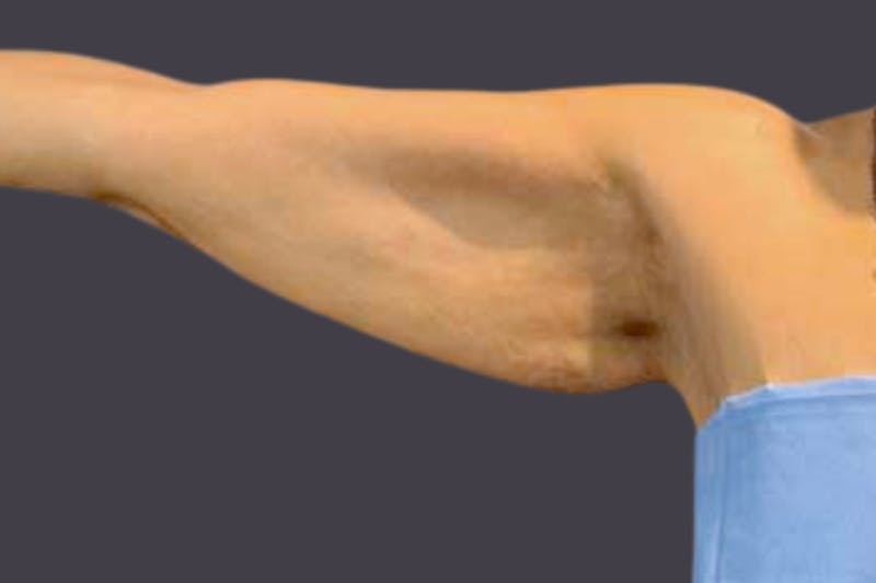 Armlift Surgery Before & After Gallery - Patient 851570 - Image 1