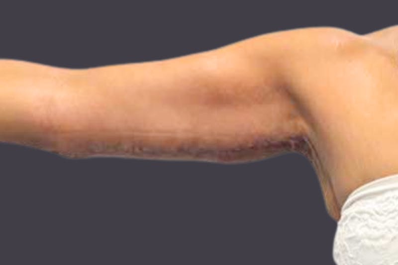 Armlift Surgery Before & After Gallery - Patient 851570 - Image 2