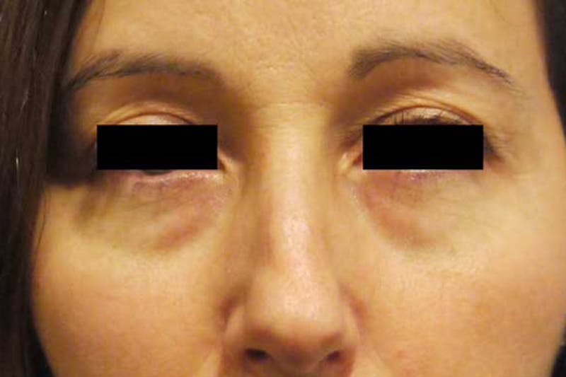 Eye Lift Before & After Gallery - Patient 339129 - Image 1