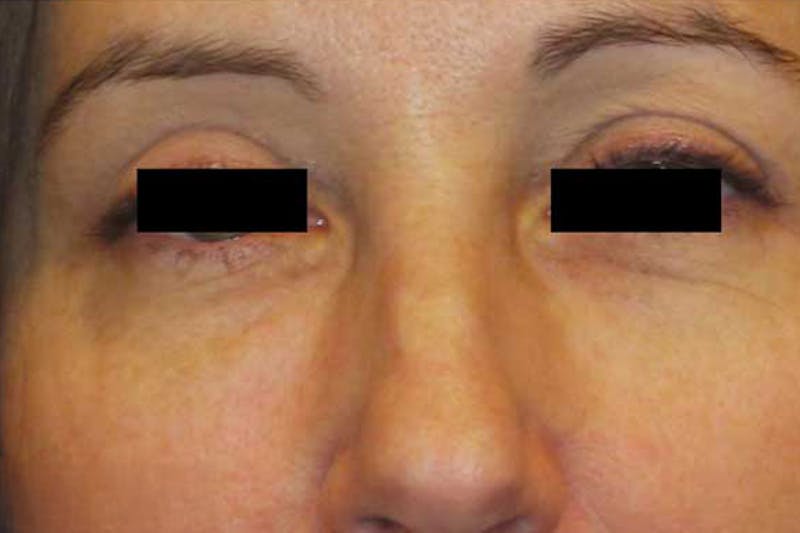 Eye Lift Before & After Gallery - Patient 339129 - Image 2