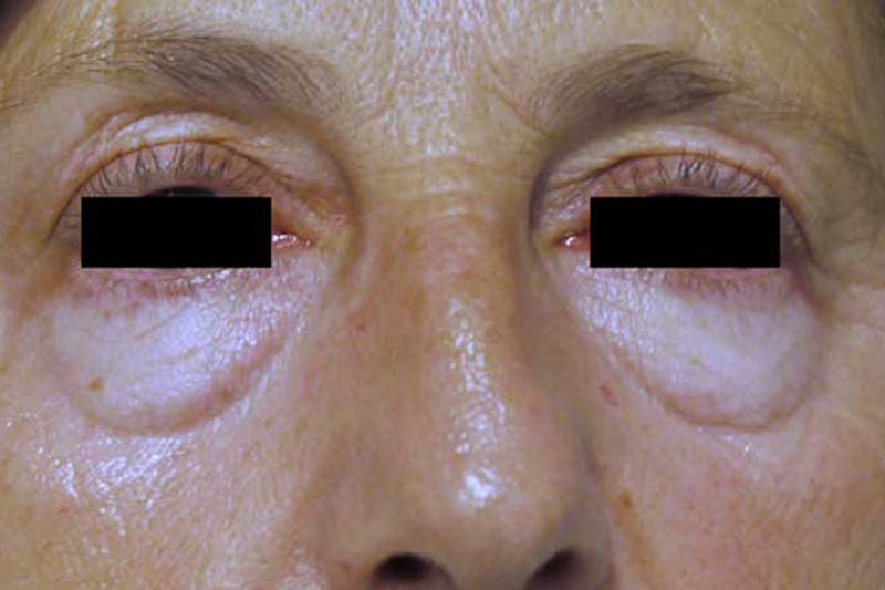 Eye Lift Before & After Gallery - Patient 258198 - Image 1