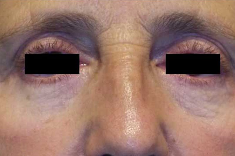 Eye Lift Before & After Gallery - Patient 258198 - Image 2