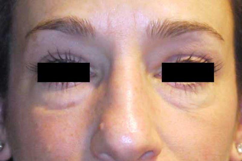 Eye Lift Before & After Gallery - Patient 403712 - Image 1