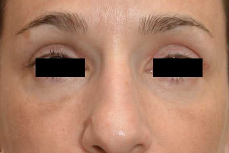 Eye Lift Before & After Gallery - Patient 403712 - Image 2