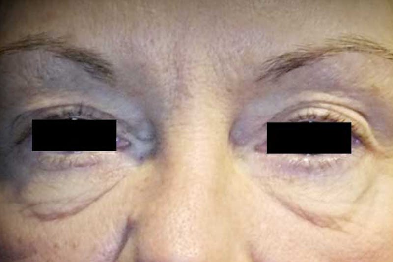 Eye Lift Before & After Gallery - Patient 169756 - Image 1