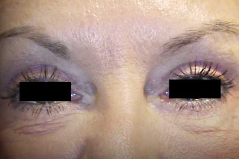 Eye Lift Before & After Gallery - Patient 169756 - Image 2