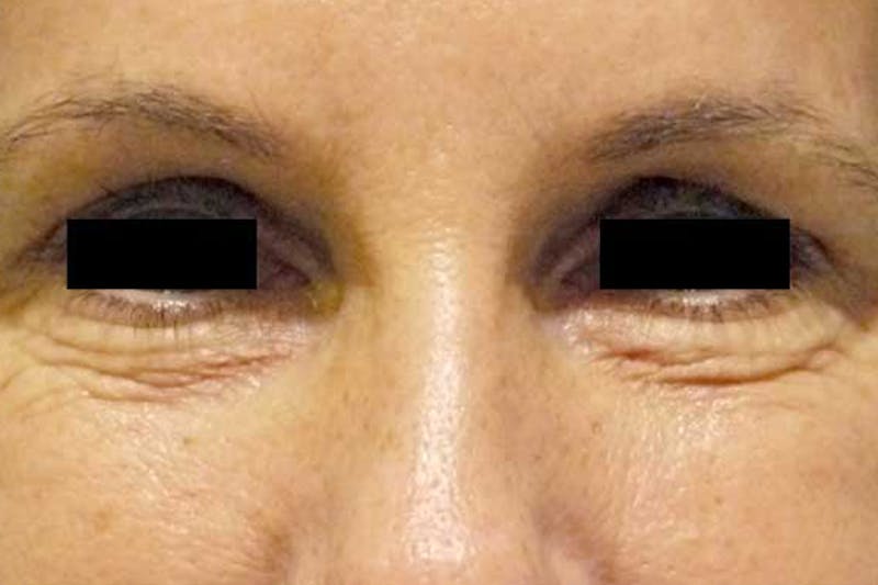Eye Lift Before & After Gallery - Patient 358472 - Image 1