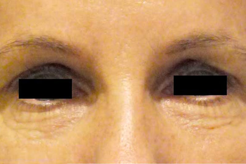Eye Lift Before & After Gallery - Patient 358472 - Image 2