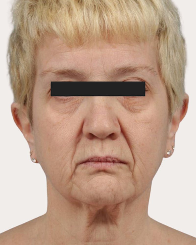 Face Lift Before & After Gallery - Patient 216381 - Image 1