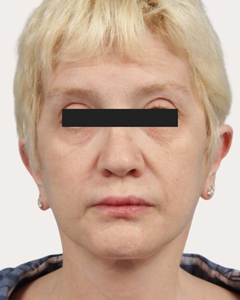 Face Lift Before & After Gallery - Patient 216381 - Image 2