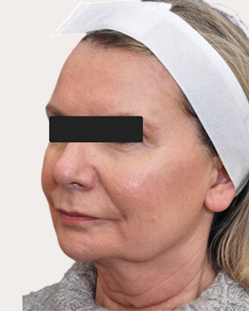 Face Lift Before & After Gallery - Patient 218996 - Image 1