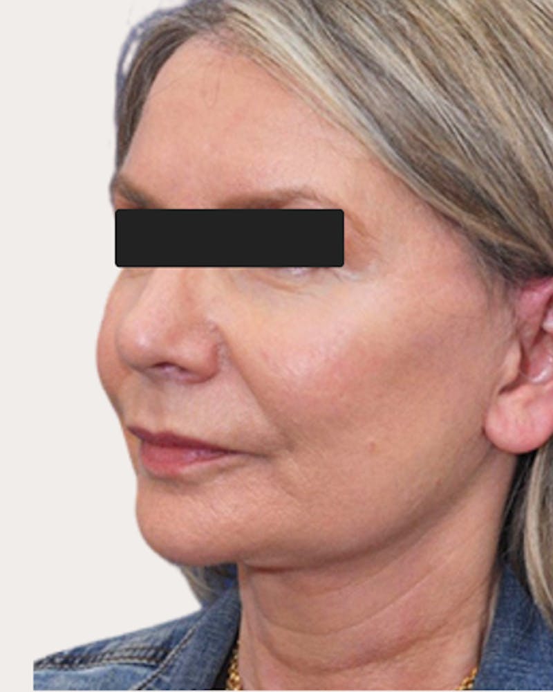 Face Lift Before & After Gallery - Patient 218996 - Image 2