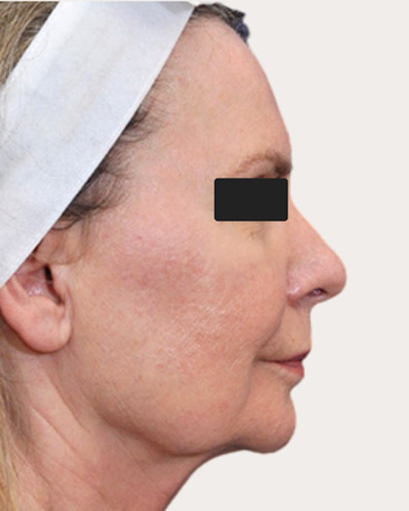 Face Lift Before & After Gallery - Patient 232039 - Image 1