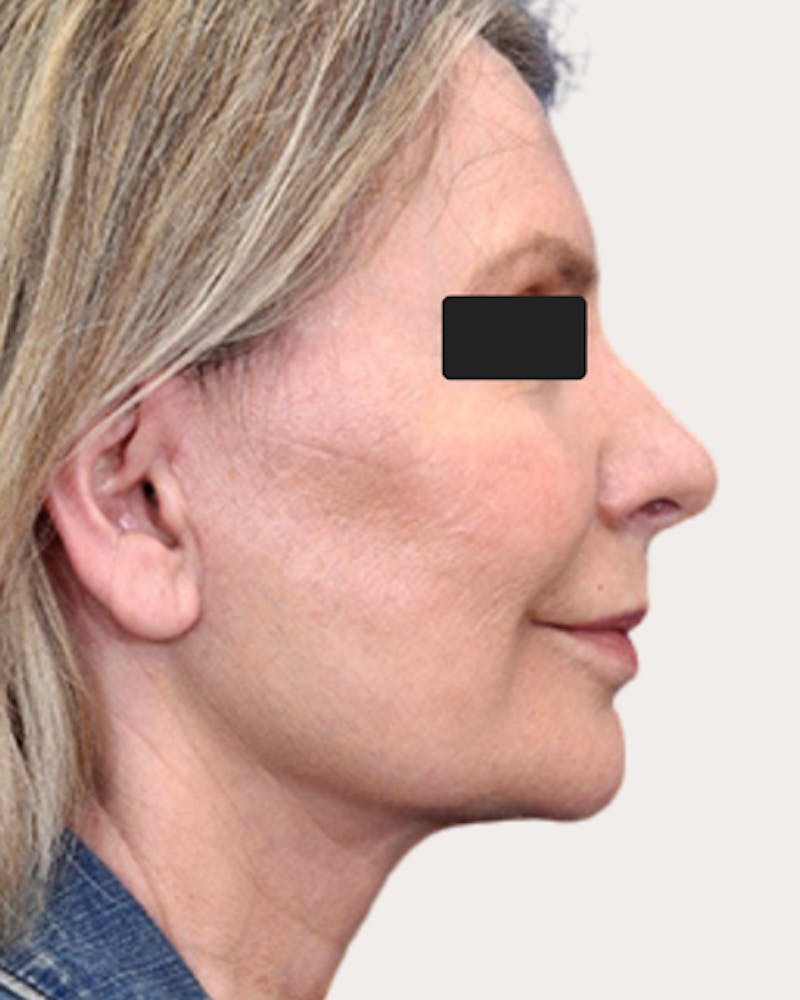 Face Lift Before & After Gallery - Patient 232039 - Image 2