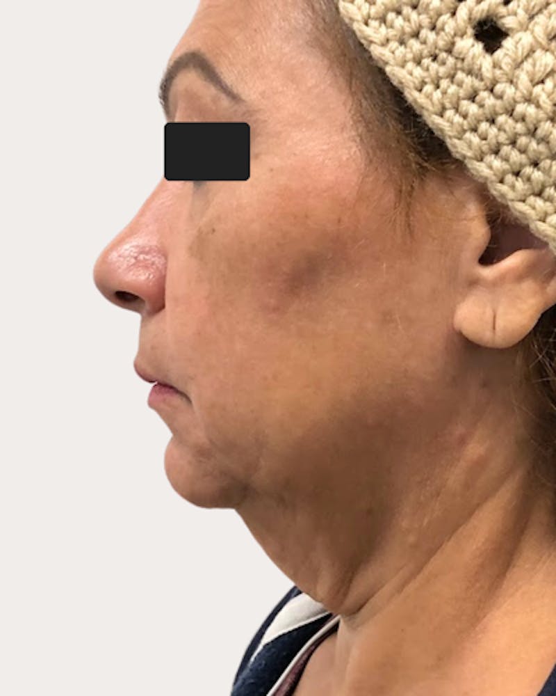 Face Lift Before & After Gallery - Patient 194507 - Image 1