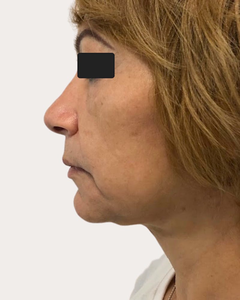 Face Lift Before & After Gallery - Patient 194507 - Image 2