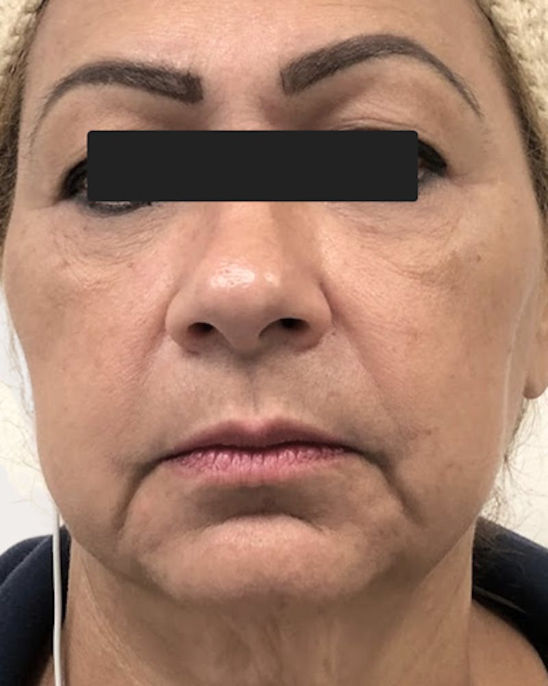 Face Lift Before & After Gallery - Patient 274740 - Image 1