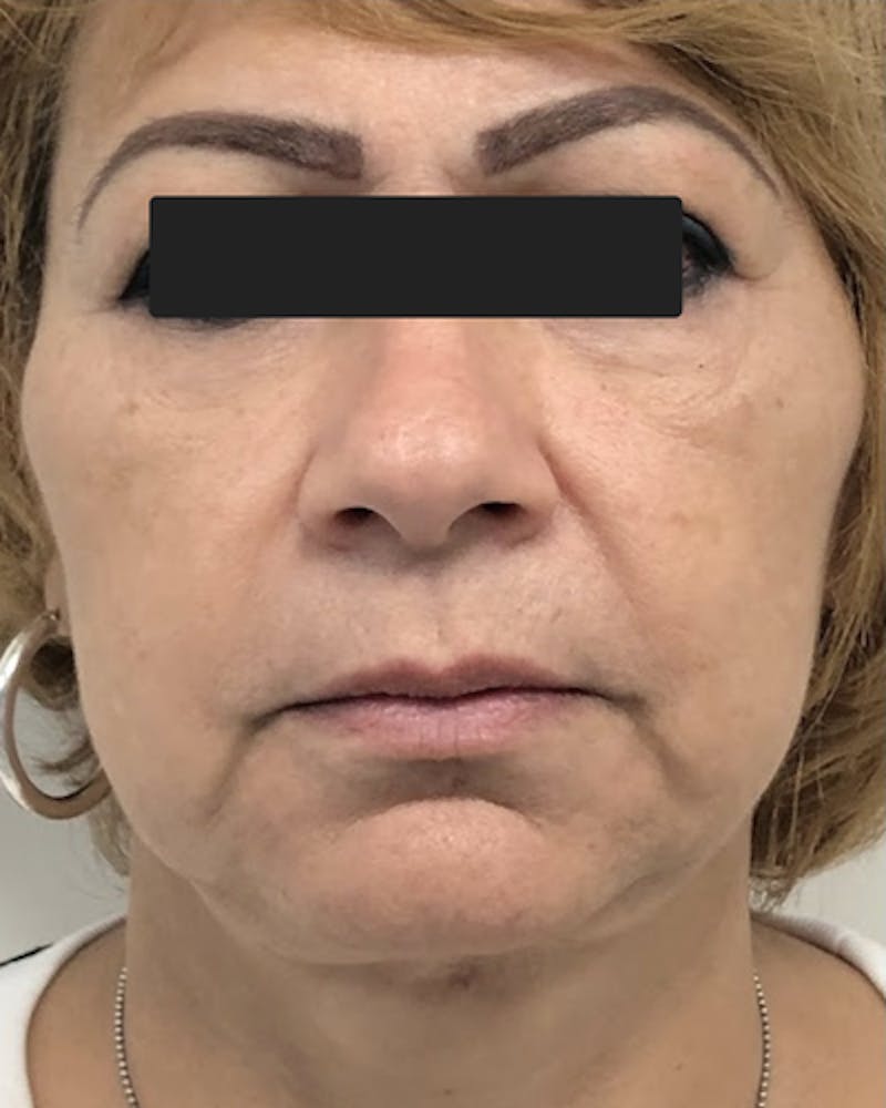 Face Lift Before & After Gallery - Patient 274740 - Image 2