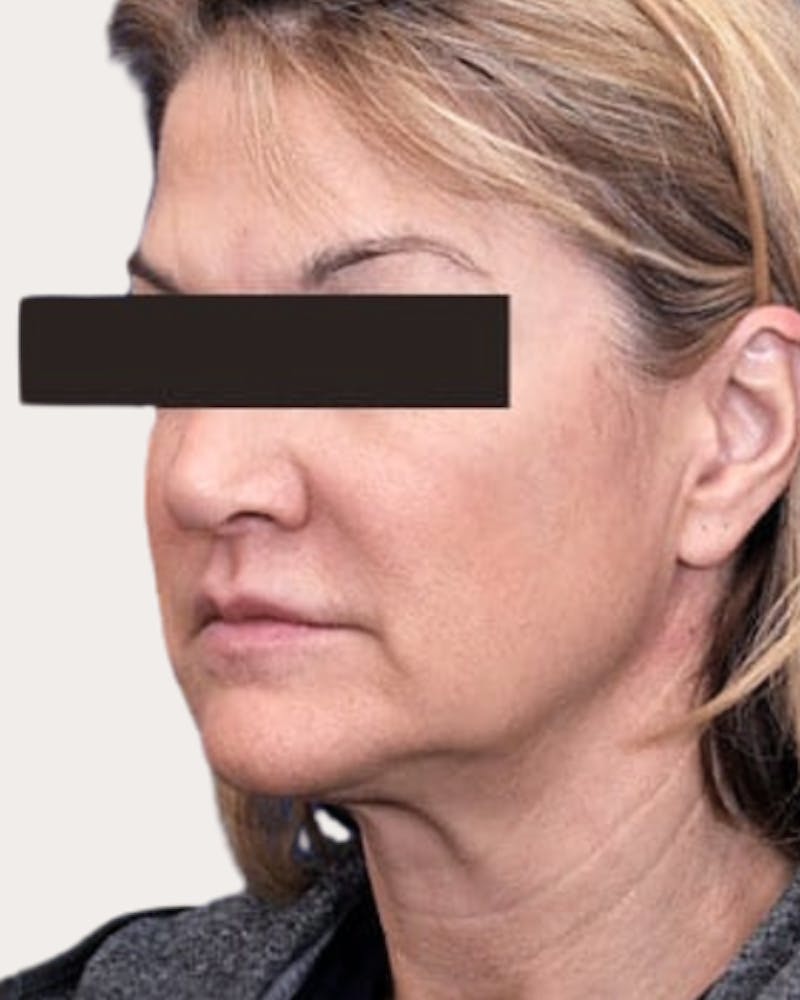 Face Lift Before & After Gallery - Patient 426131 - Image 1