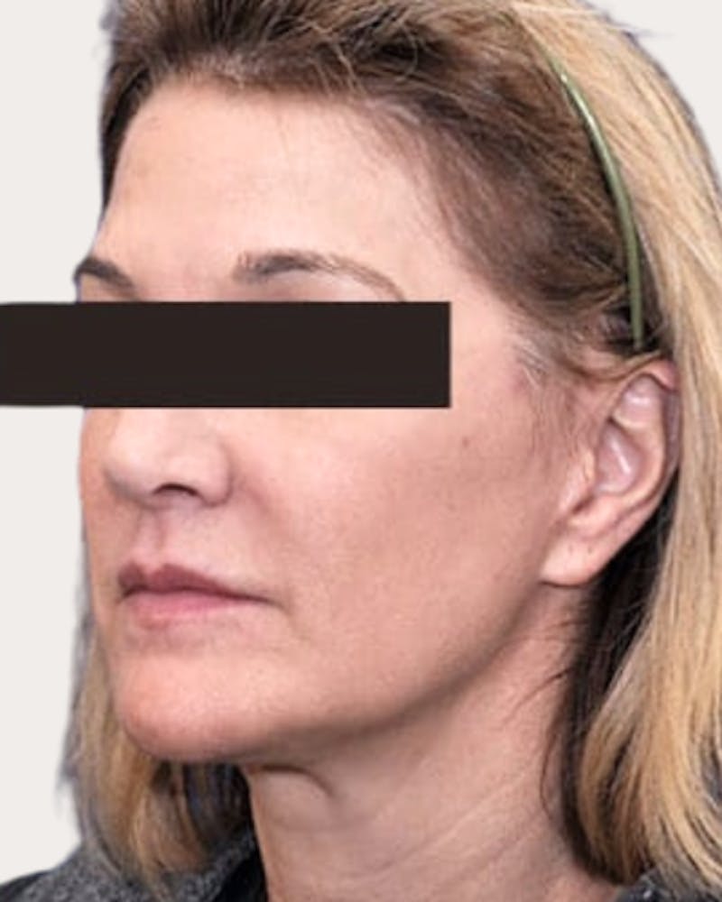 Face Lift Before & After Gallery - Patient 426131 - Image 2