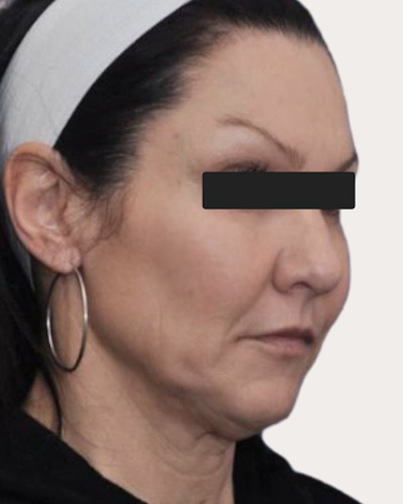 Face Lift Before & After Gallery - Patient 203976 - Image 1