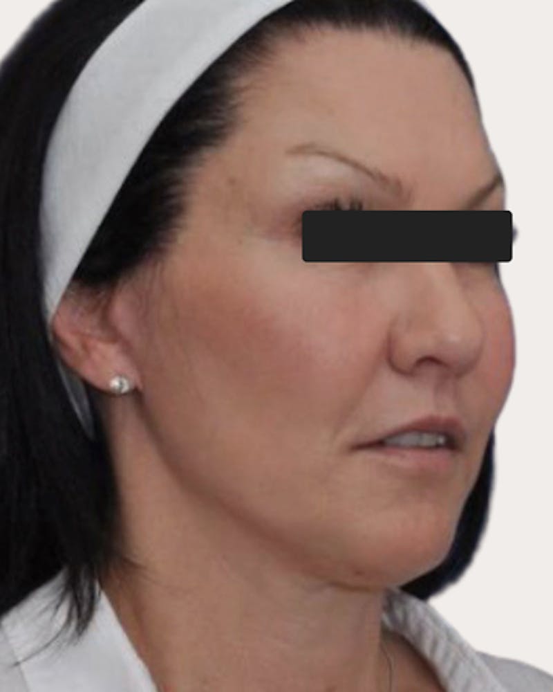 Face Lift Before & After Gallery - Patient 203976 - Image 2