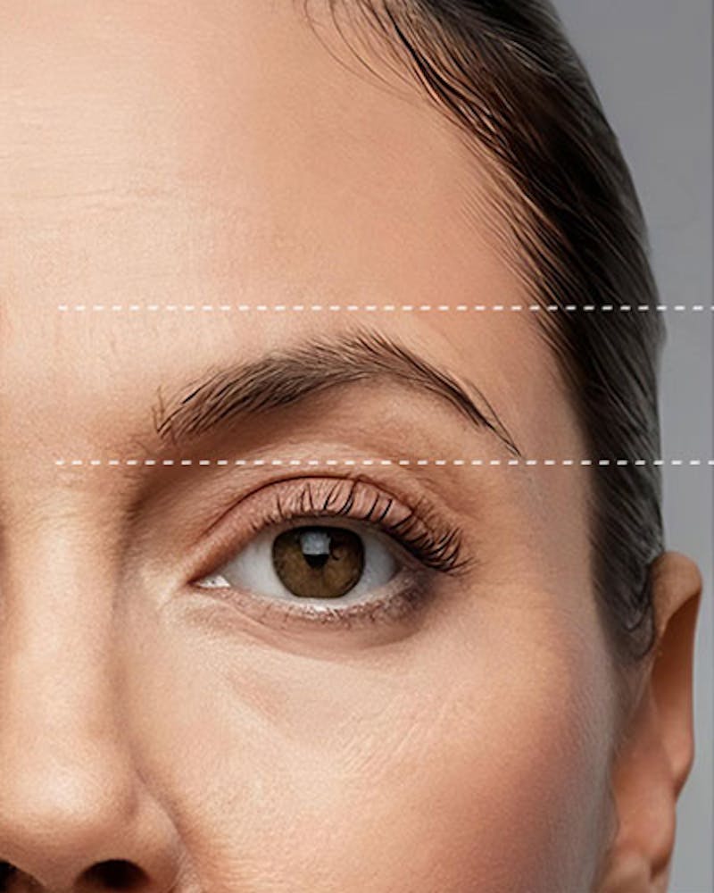 Forehead and Brow Lift Before & After Gallery - Patient 297850 - Image 1