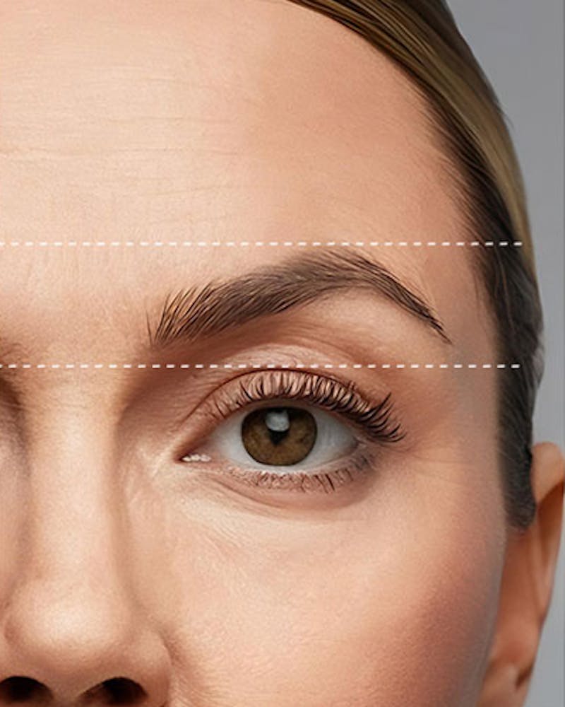 Forehead and Brow Lift Before & After Gallery - Patient 297850 - Image 2