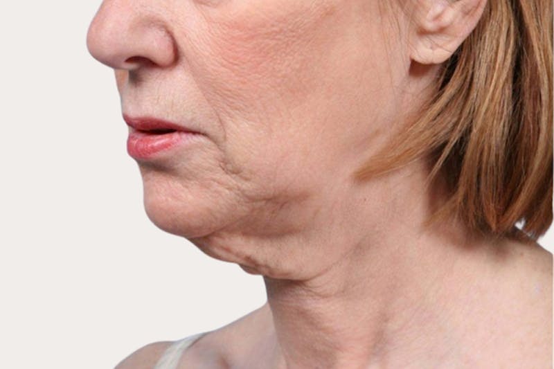 Neck Lift Surgery Before & After Gallery - Patient 369859 - Image 1