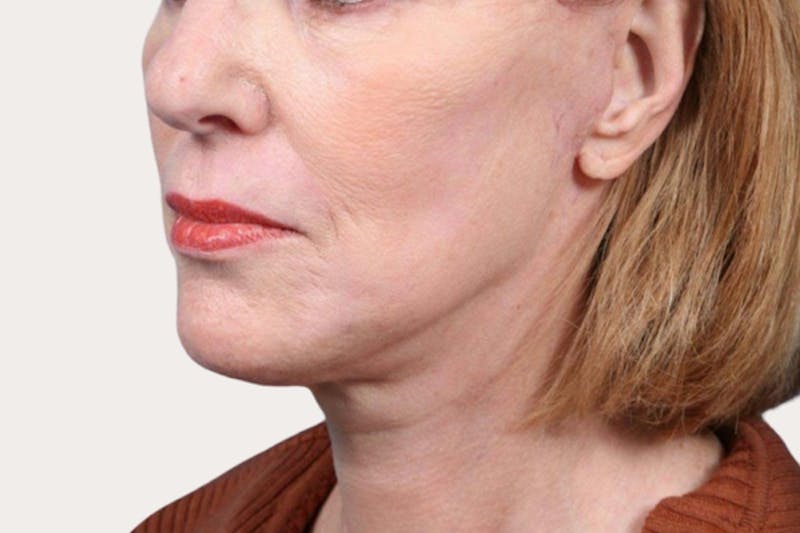 Neck Lift Surgery Before & After Gallery - Patient 369859 - Image 2