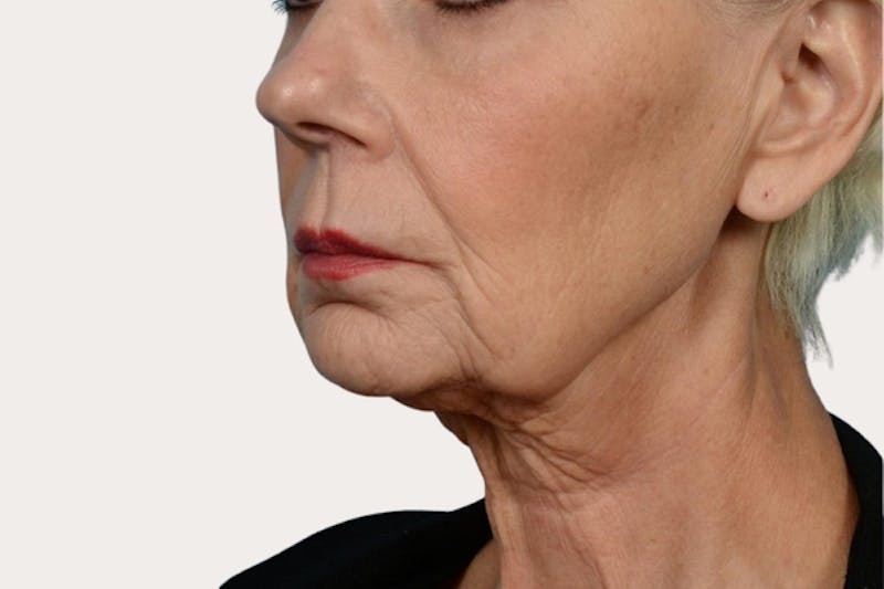 Neck Lift Surgery Before & After Gallery - Patient 307380 - Image 1