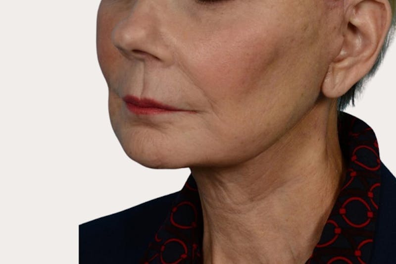 Neck Lift Surgery Before & After Gallery - Patient 307380 - Image 2