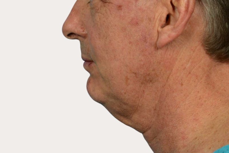 Neck Lift Surgery Before & After Gallery - Patient 418196 - Image 1