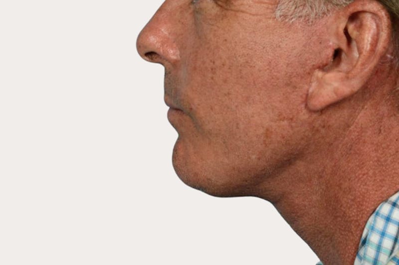 Neck Lift Surgery Before & After Gallery - Patient 418196 - Image 2