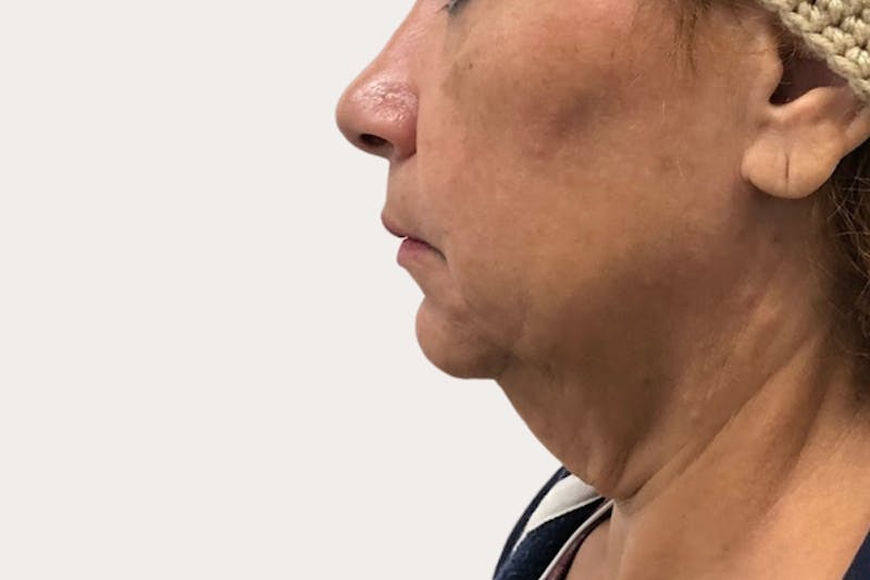 Neck Lift Surgery Before & After Gallery - Patient 392422 - Image 1