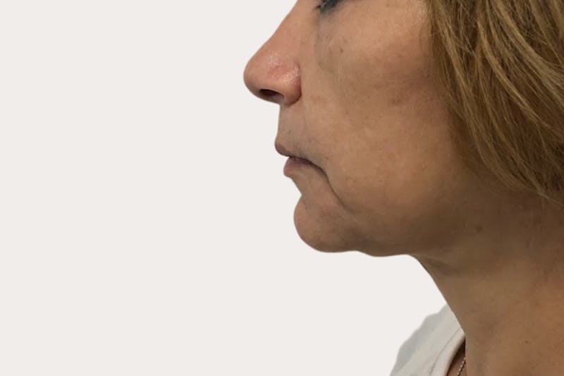 Neck Lift Surgery Before & After Gallery - Patient 392422 - Image 2