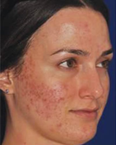 Acne Scar Treatment with Microneedling Before & After Gallery - Patient 429563 - Image 1