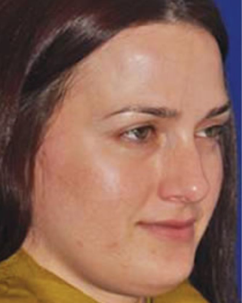 Acne Scar Treatment with Microneedling Before & After Gallery - Patient 429563 - Image 2