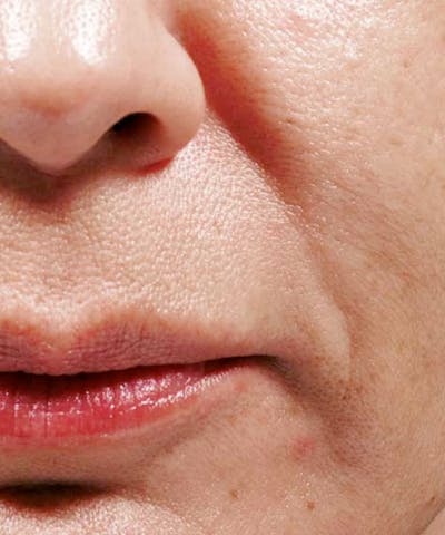 Bellafill Before & After Gallery - Patient 344057 - Image 1