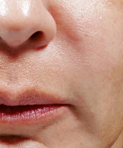Bellafill Before & After Gallery - Patient 344057 - Image 2