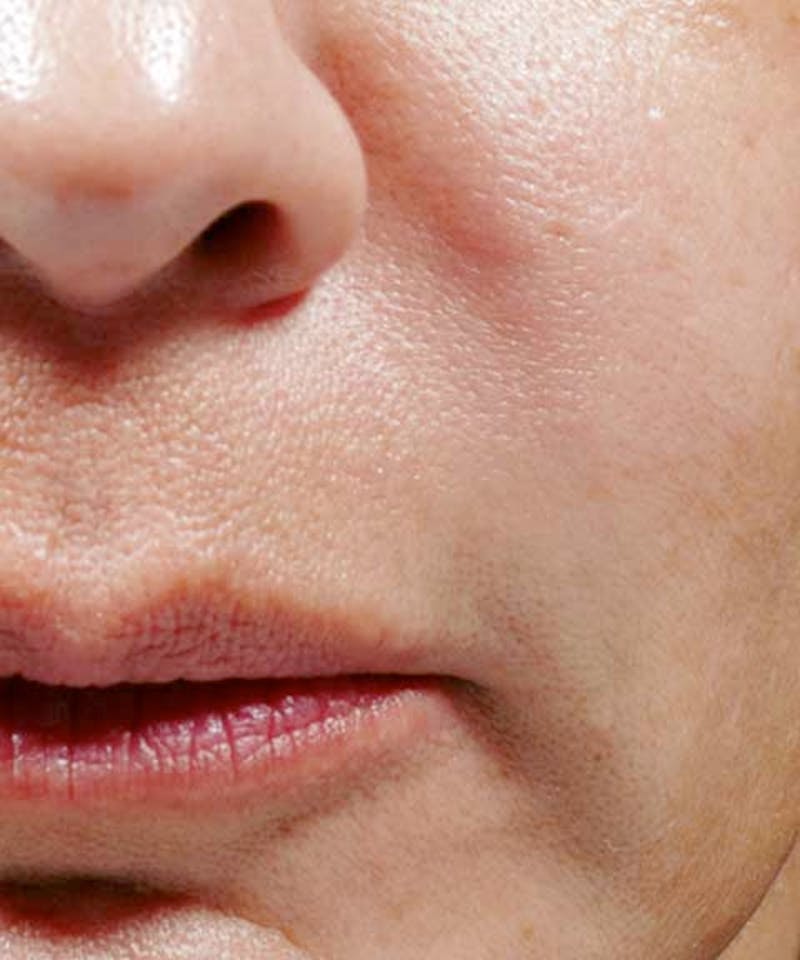Bellafill Before & After Gallery - Patient 344057 - Image 2