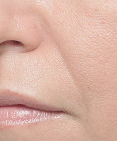 Bellafill Before & After Gallery - Patient 329313 - Image 1