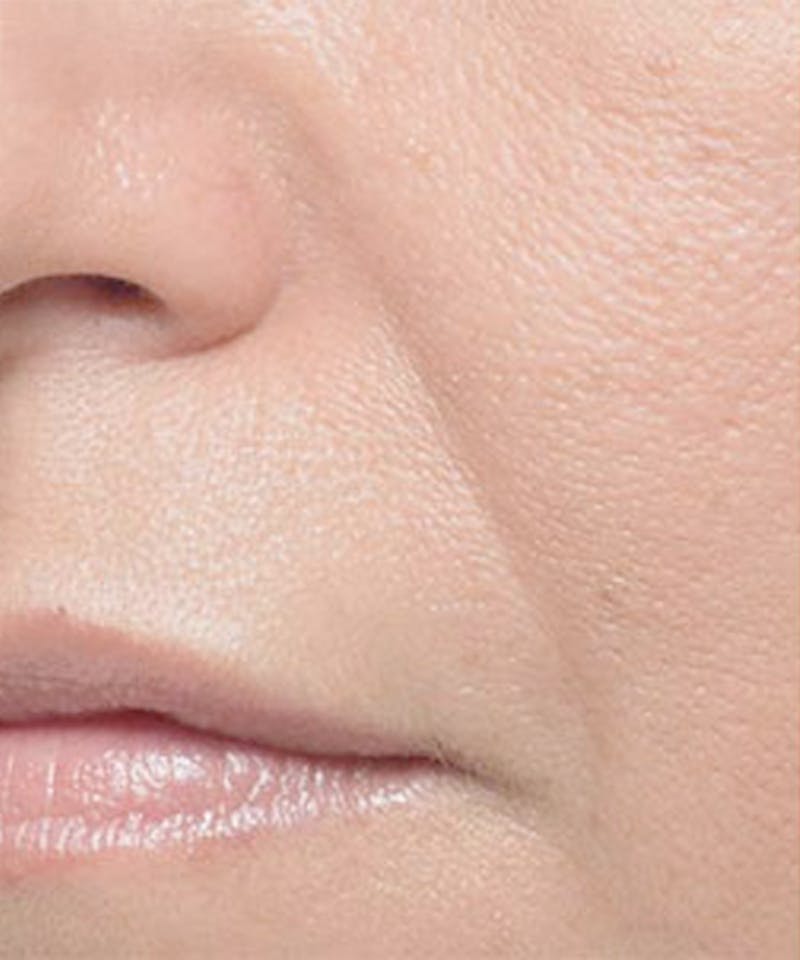 Bellafill Before & After Gallery - Patient 329313 - Image 1