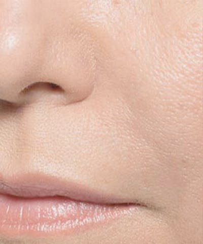Bellafill Before & After Gallery - Patient 329313 - Image 2